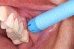 Flex Saliva Ejector - Image 4