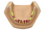 IMPLANT BAR