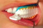Moldex Impression Tray - Image 7