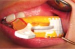 Moldex Impression Tray - Image 9