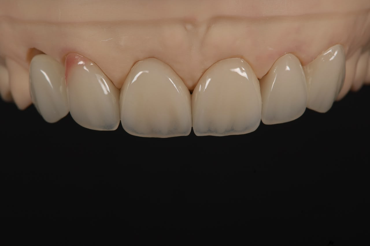 Close-up of anterior restorations showing shape and surface detail