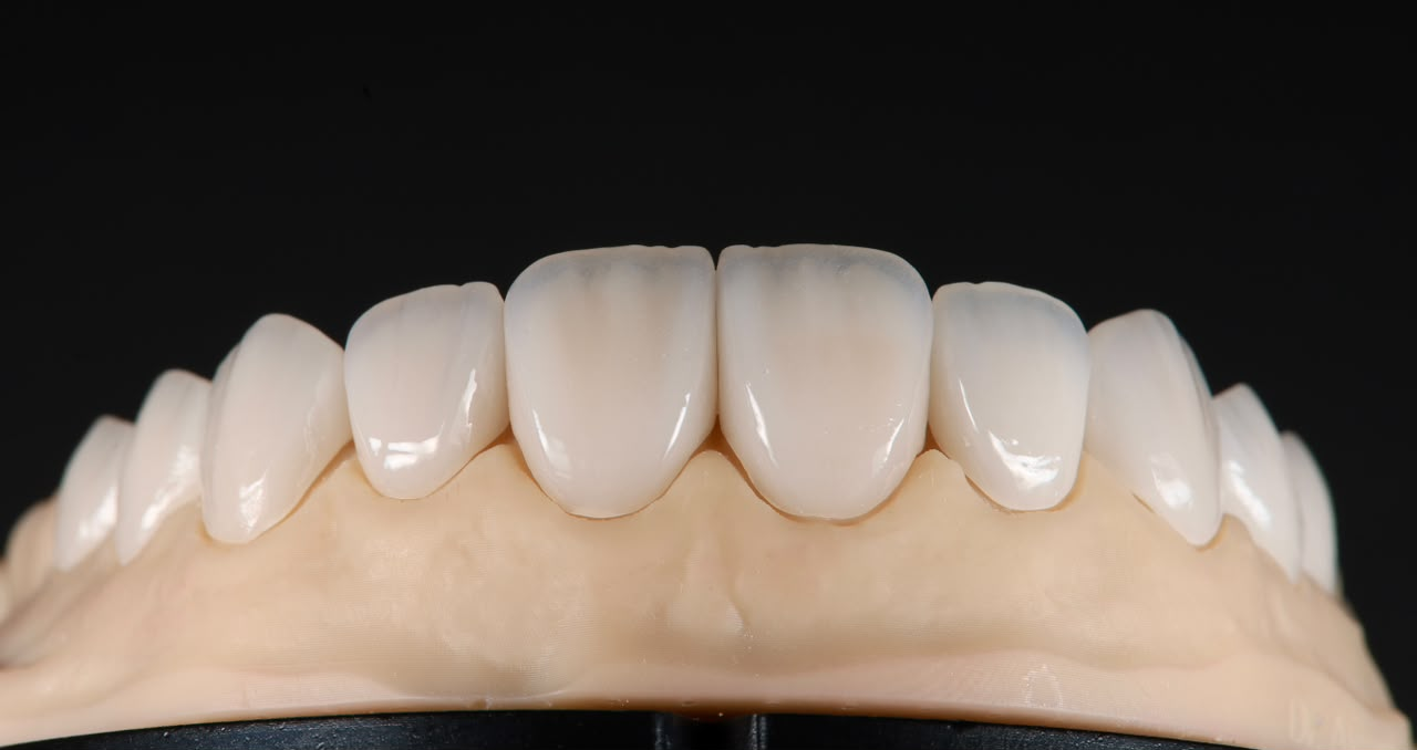 Anterior restorations on a laboratory model from Emotion Dental Laboratory