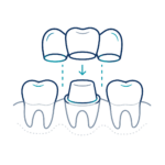 Temporary Restorations